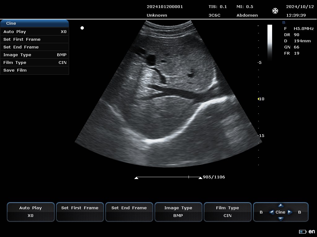 Liver B-mode