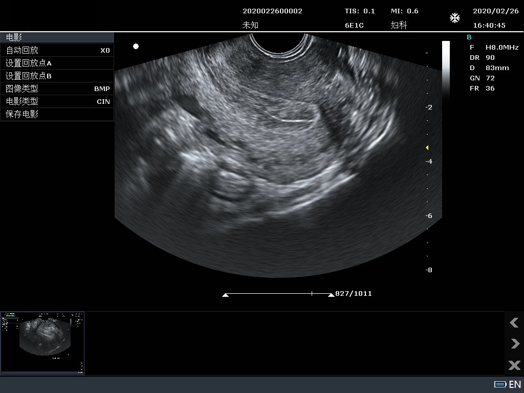 Uterus B-mode