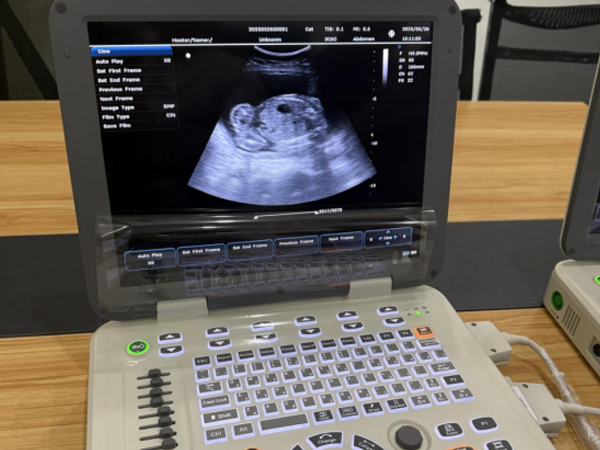 Introducing the N20: SONOIMAGE’s Newest Portable Color Doppler Ultrasound
