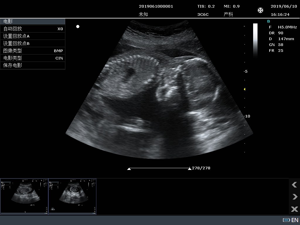 Fetal Upper Limb B-mode
