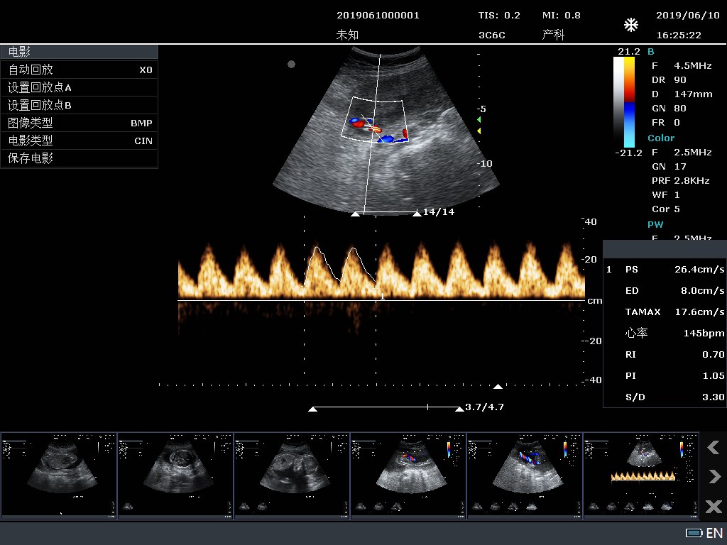 Umbilical Artery PW Auto Envelope