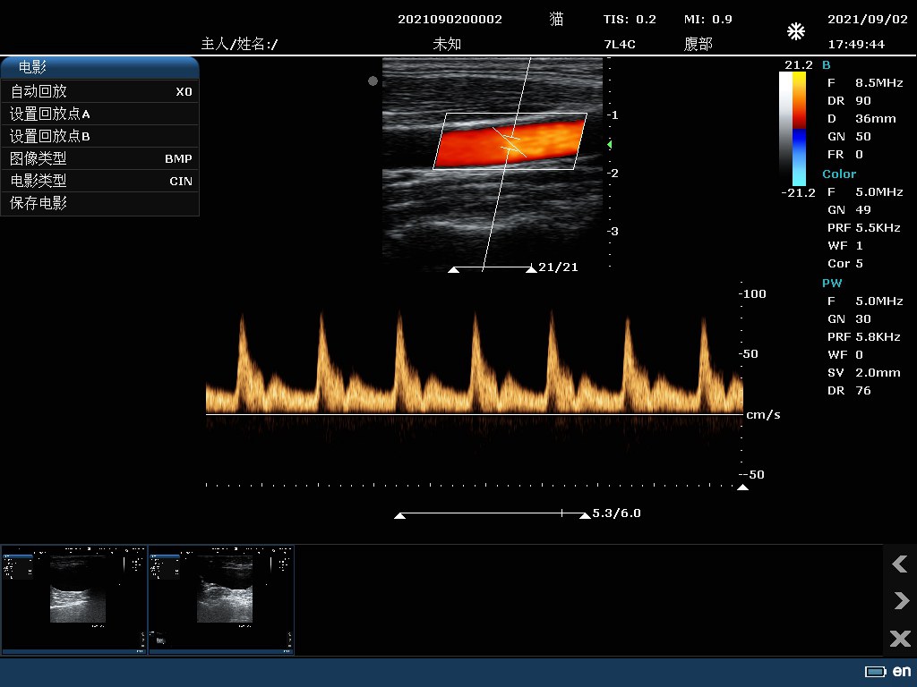 Carotid Artery BCD-mode