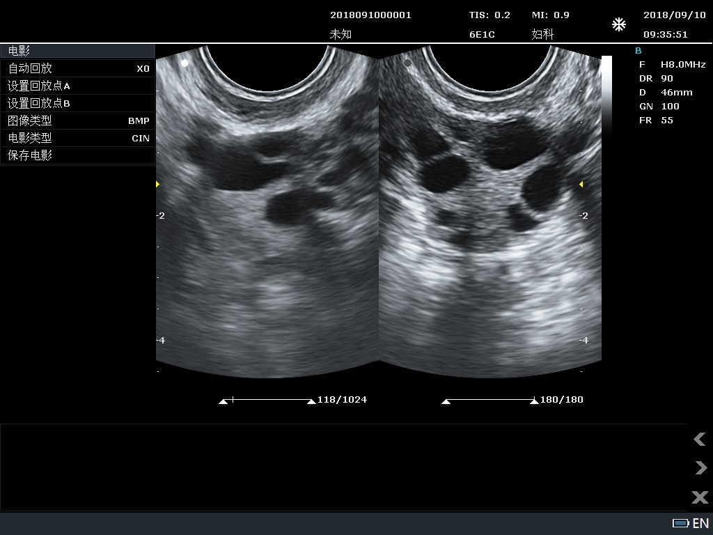 Follicle B-mode