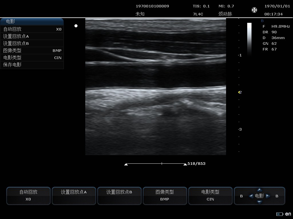 Carotid Artery B-mode
